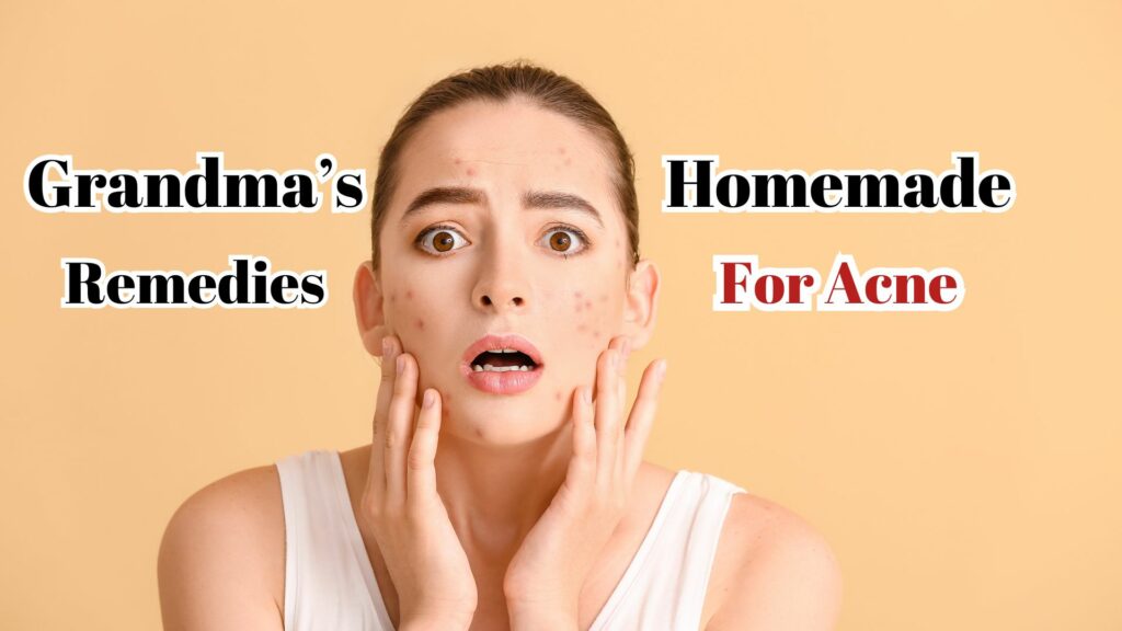 Grandma's Home Remedies For Acne