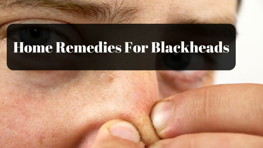 home remedies for blackheads