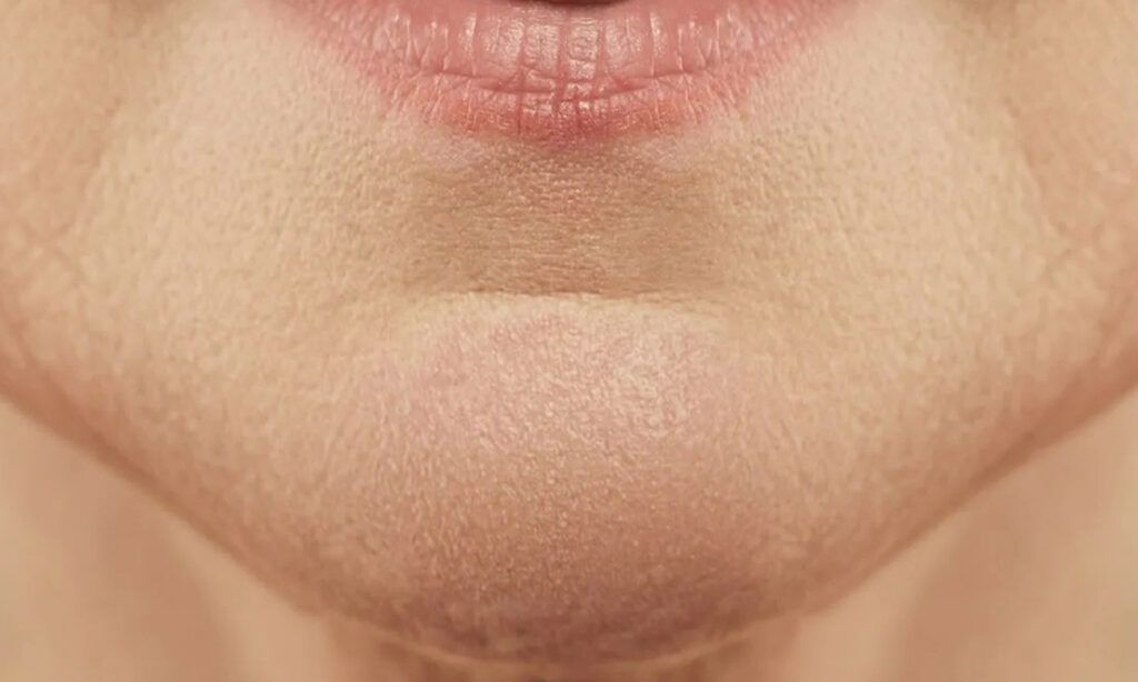 What Is Chin Crease And How To Treat It?